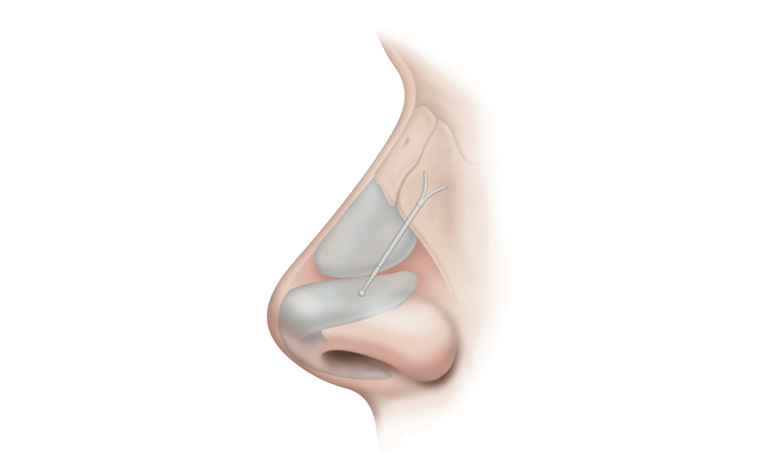 Absorbable Nasal Implant Devices Market