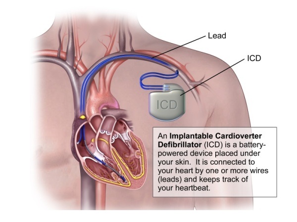 Cardiac Implantable Electronic Device