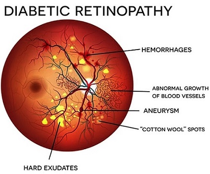 Diabetic Retinopathy