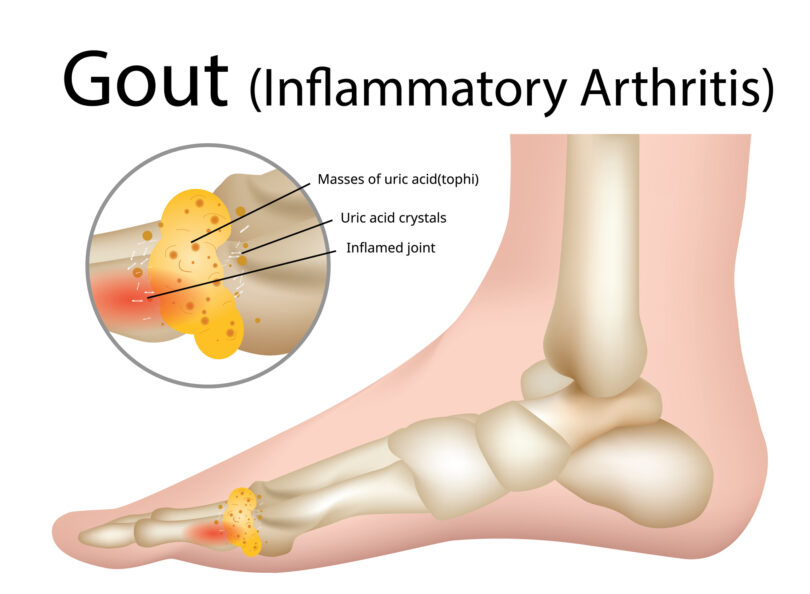 Gout Disease Treatment Market