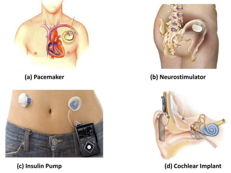 Implantable Medical Devices