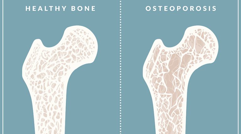 Osteoporosis