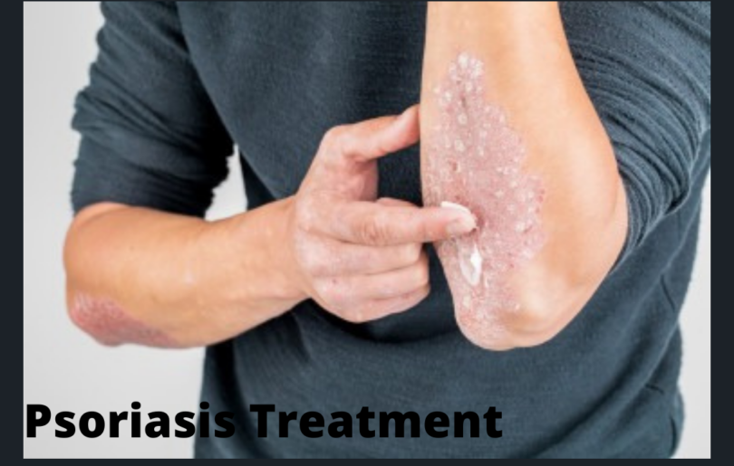 Psoriasis Treatment