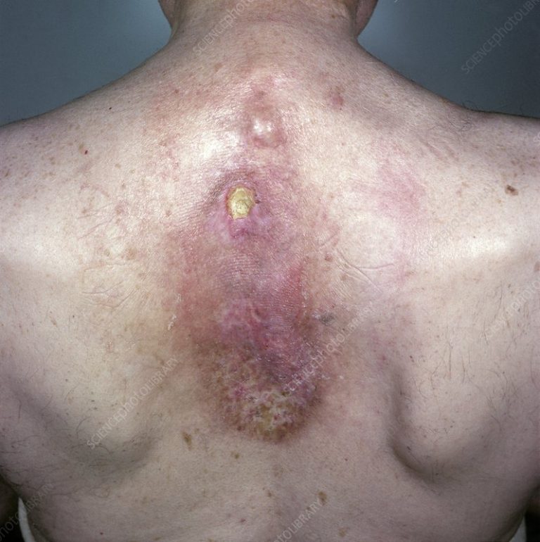 Radiodermatitis