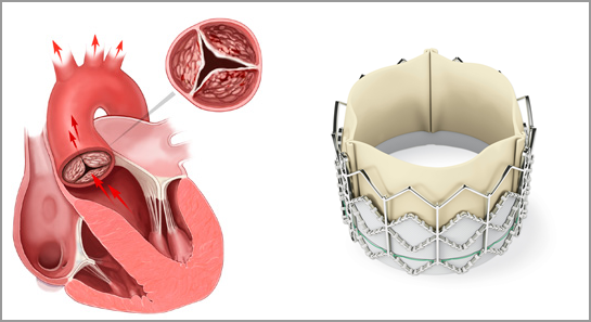 Transcatheter Heart Valve