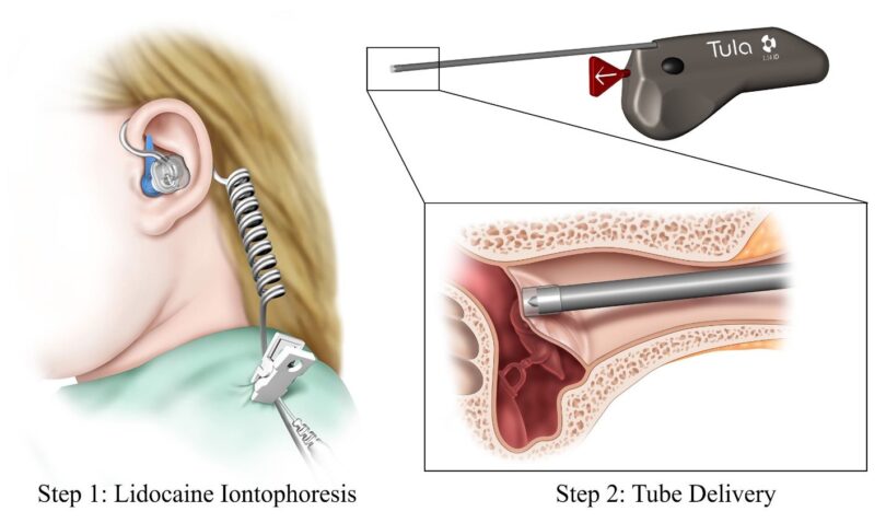 Tympanostomy Products Market